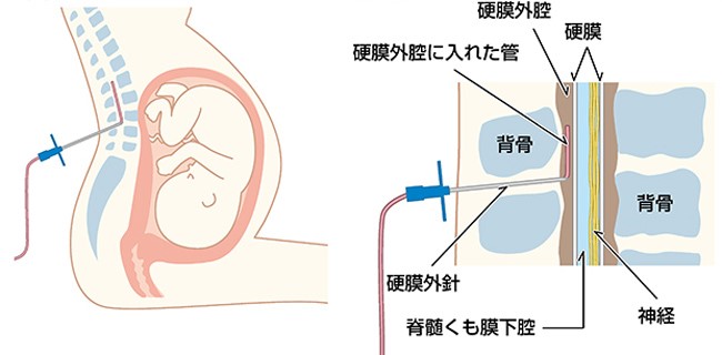 無痛分娩